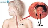 انجام عمل جراحی  بسیار پیچیده سرطان مری در بیمارستان گراش