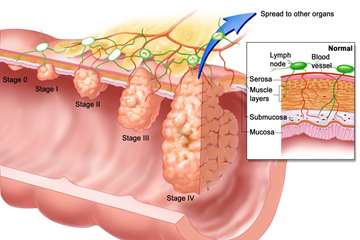 Symptoms-Of-Esophageal-Cancer-2